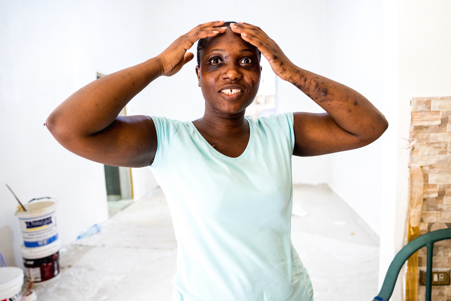 Agbakey says she loved her long hair, but doctors had to shave her head to stitch it. Karantina, Lebanon. August 31, 2020. (Lynn Chaya/The Public Source)